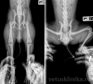 Перелом левой подвздошной кости и левой вертлужной впадины Rtg v/d